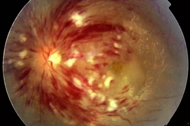 高血压视网膜病变出血长斑图