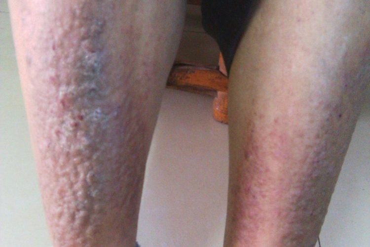 播散性慢性单纯苔藓图