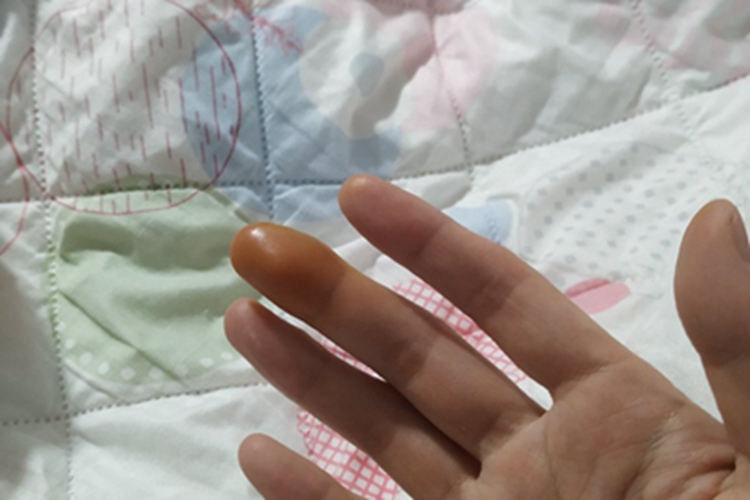 脓性指头炎手指肿图 脓性指头炎手指肿图