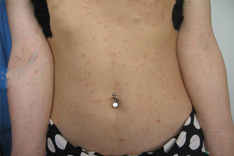 男性二期梅毒全身症状图