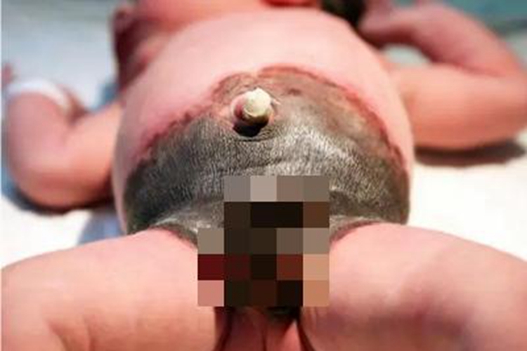 兽皮痣腹部黑斑图