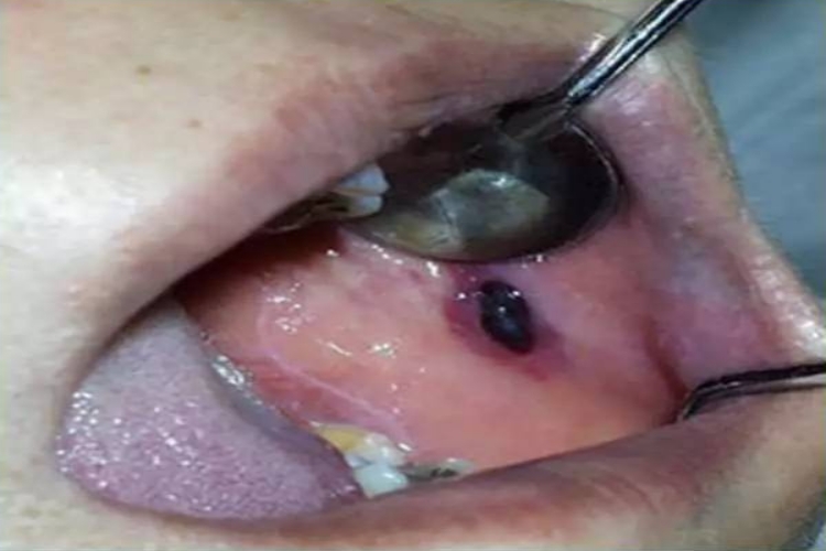 黏膜黑斑图 黏膜黑斑图