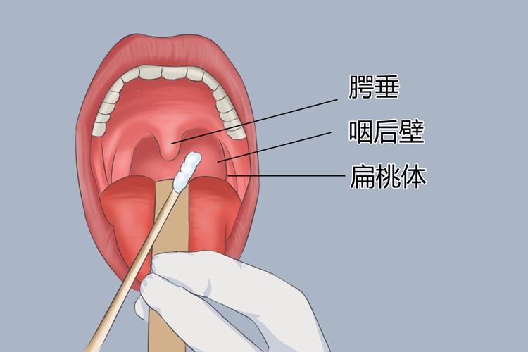 采核酸咽喉部准确部位图片