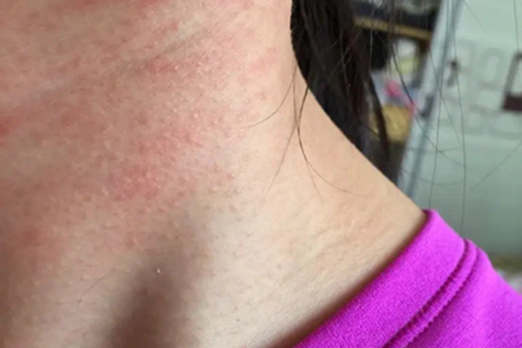 类癌综合征小疙瘩图