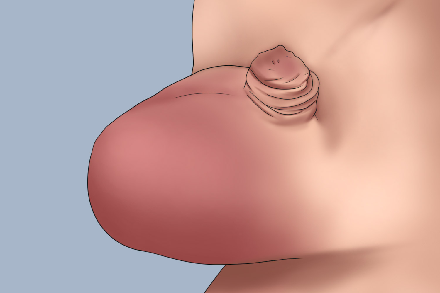 小儿精索扭转阴囊红肿图 小儿精索扭转阴囊红肿图