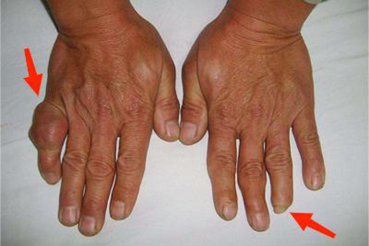 腱鞘巨细胞瘤手指变形图 腱鞘巨细胞瘤手指变形图