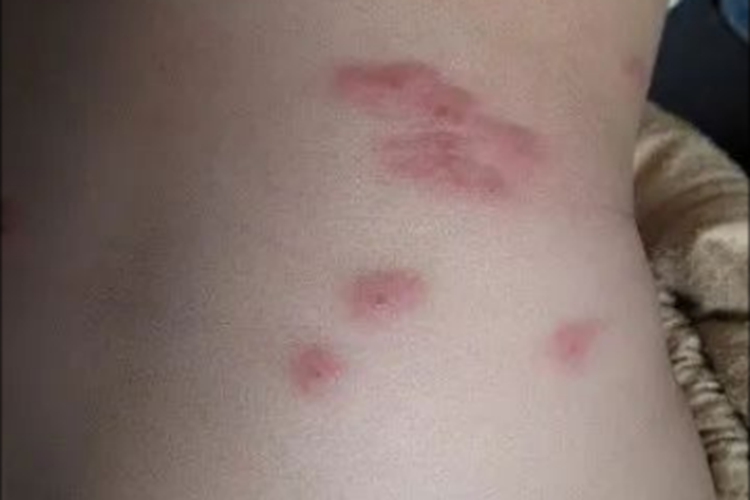 虫咬皮炎腰部红斑图