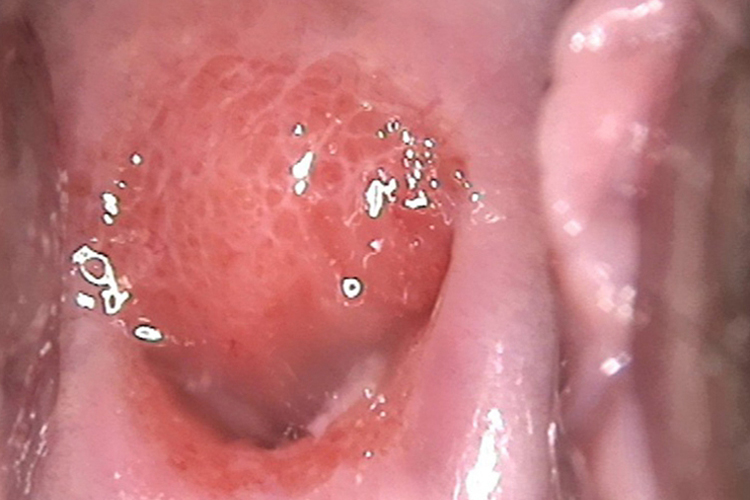 急性宫颈炎黏膜外翻图