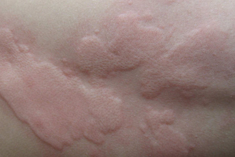 真菌过敏荨麻疹图