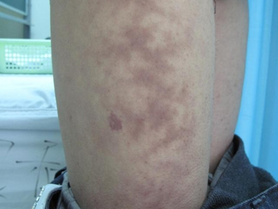 特发性网状青斑大腿网状紫色斑块图.jpg