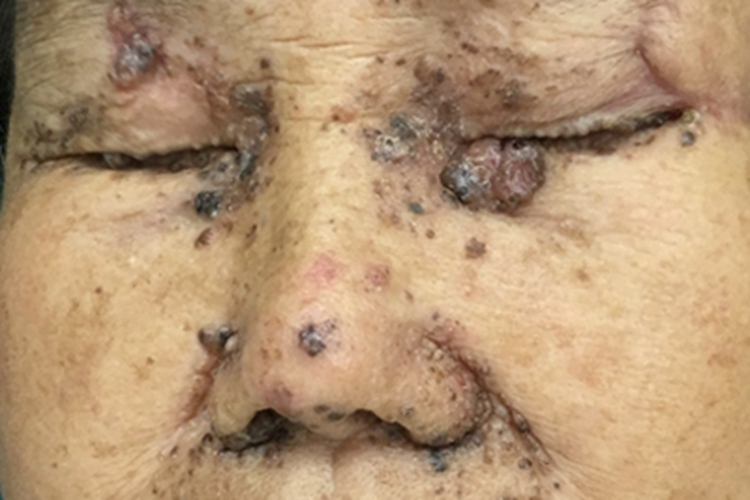基底细胞瘤面部症状图