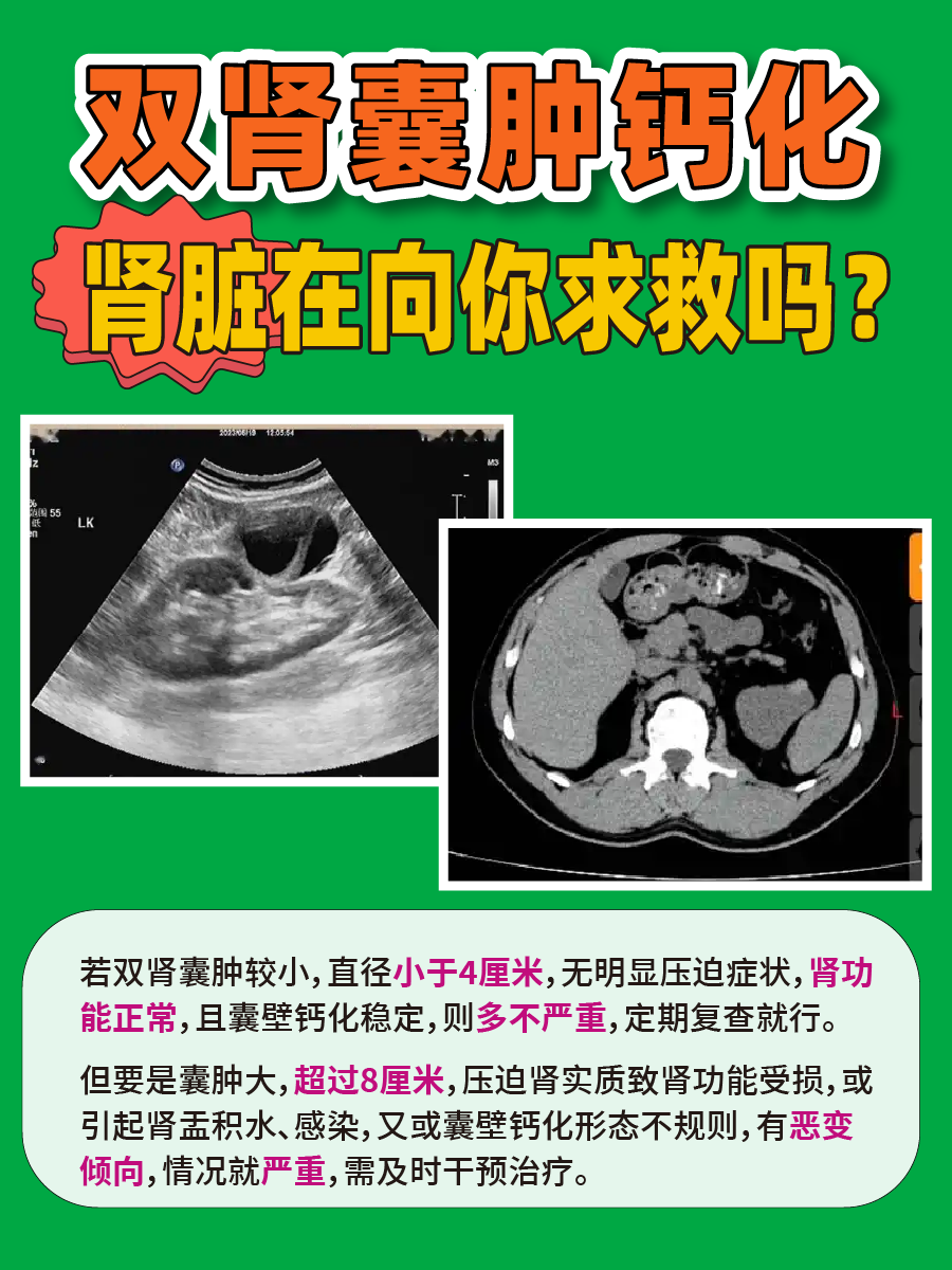 双肾囊肿钙化，肾脏在向你求救吗？