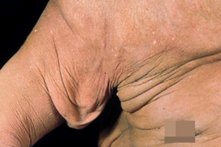 肉芽肿性皮肤松弛症胳膊症状图