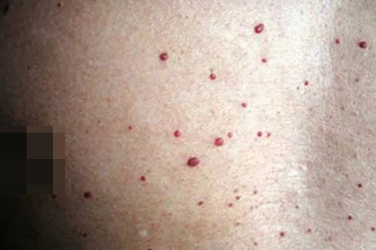 巴尔通体病胸部症状图