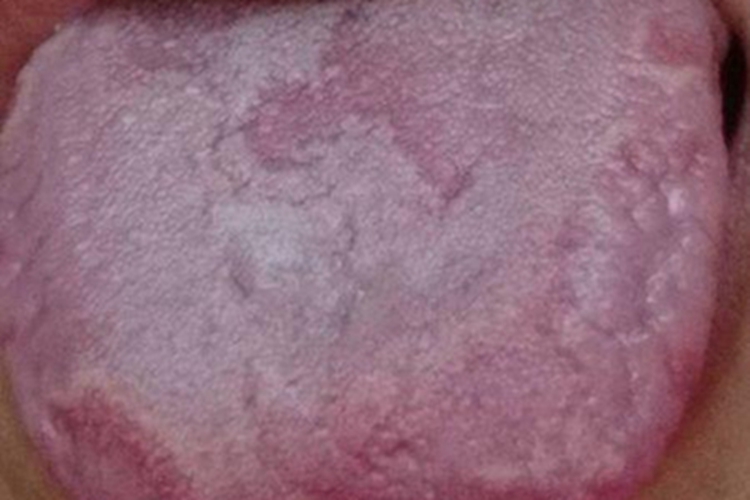 口腔毛状黏膜白斑舌面白斑块图