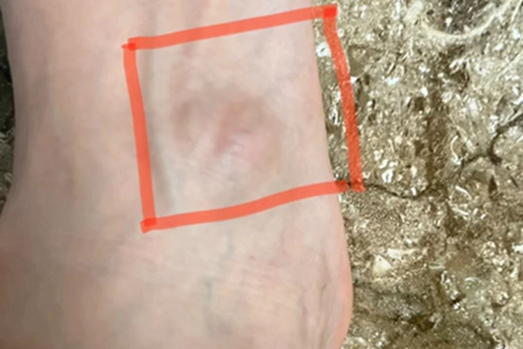 腱鞘纤维瘤脚背肿块图