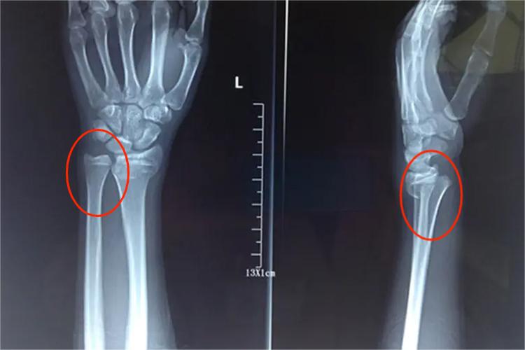 左手手腕Colles骨折X光片图