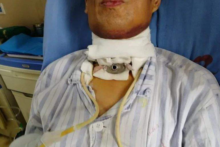 喉癌术后造瘘口图