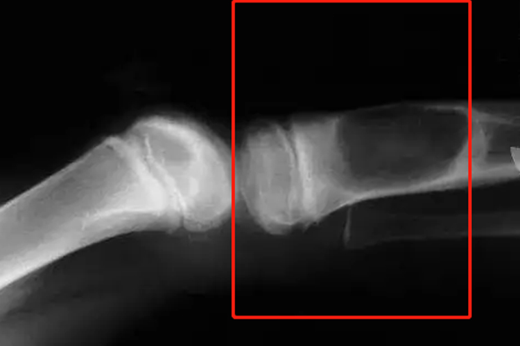 长骨干骺端骨囊肿影像学图 长骨干骺端骨囊肿影像学图
