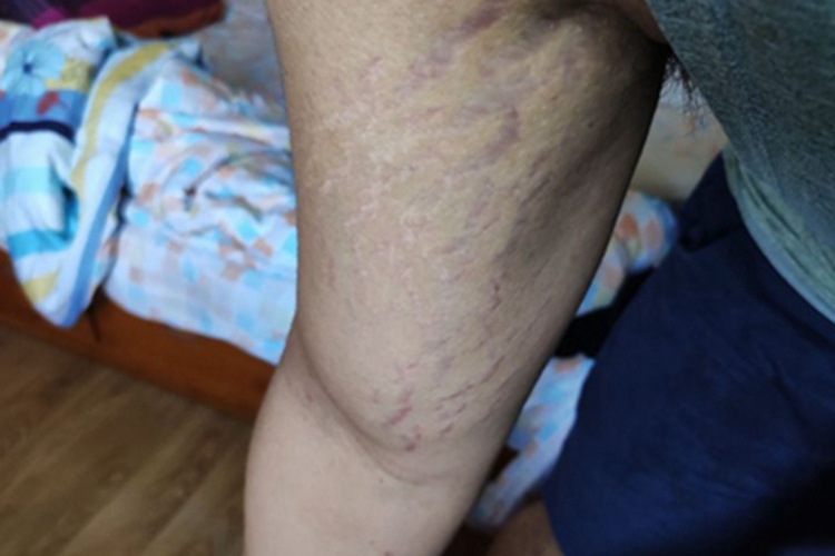 胳膊萎缩纹症状图