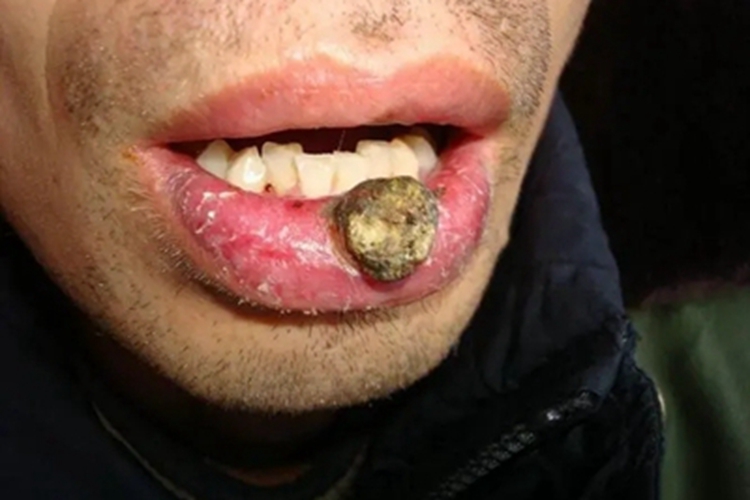 头部鳞状细胞癌嘴唇症状图