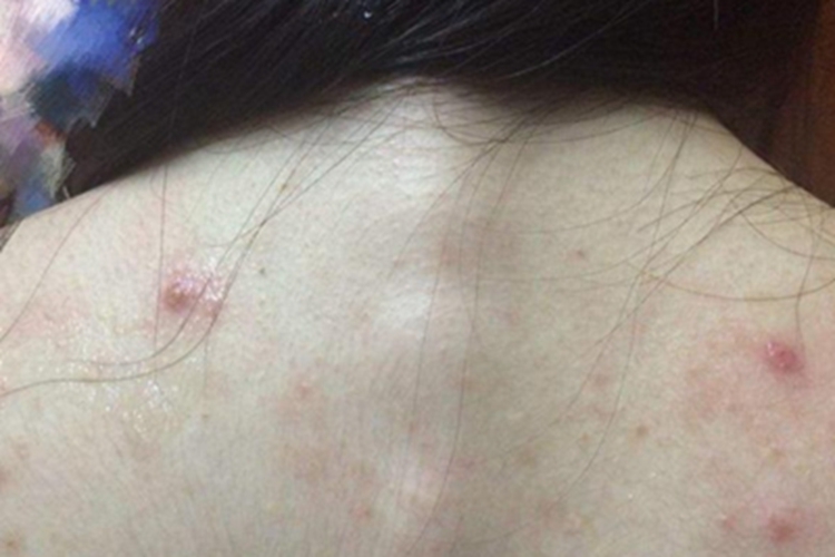 淋巴瘤样丘疹病背部丘疹图 淋巴瘤样丘疹病背部丘疹图