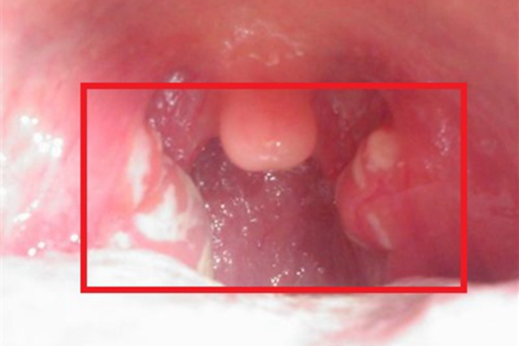 慢性鼻咽炎咽后壁红肿图
