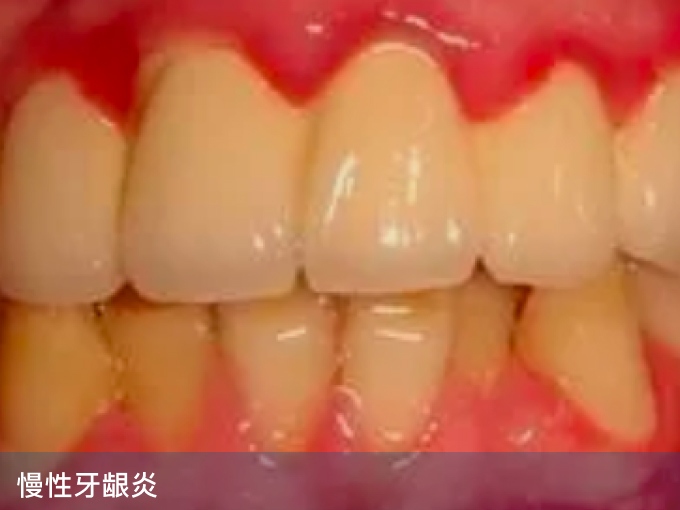慢性牙龈炎