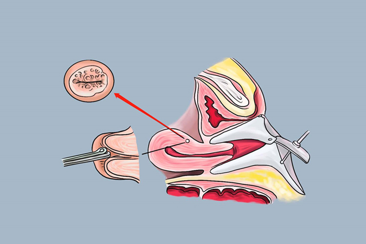 宫颈活检钳取米粒大小宫颈组织图