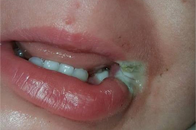 电烧伤嘴唇症状图