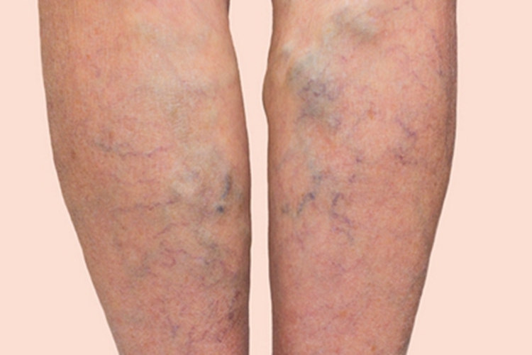 游走性血栓性浅静脉炎小腿症状图