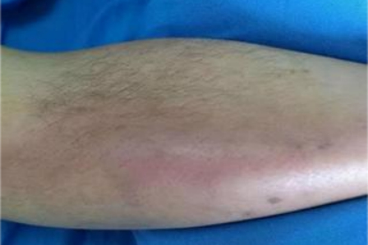 下肢深静脉血栓小腿发红肿胀图 下肢深静脉血栓小腿发红肿胀图