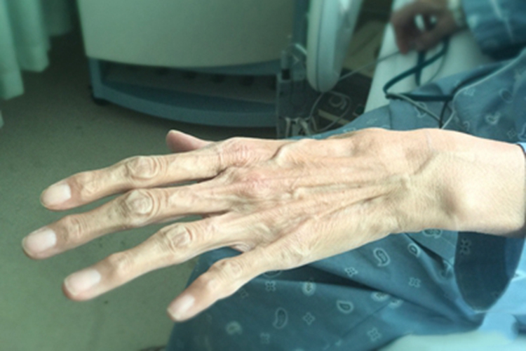 马方综合征手指细长图