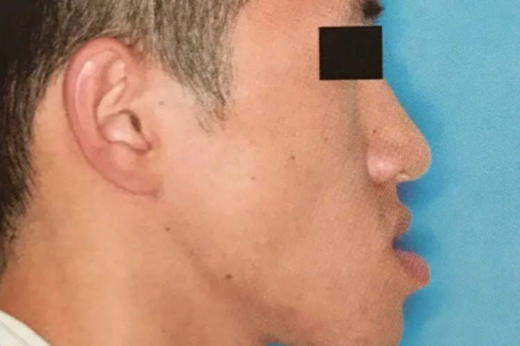 下颌前突畸形面部图