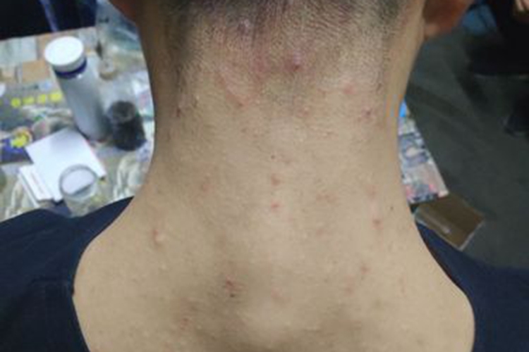 毛囊炎颈部长疙瘩图