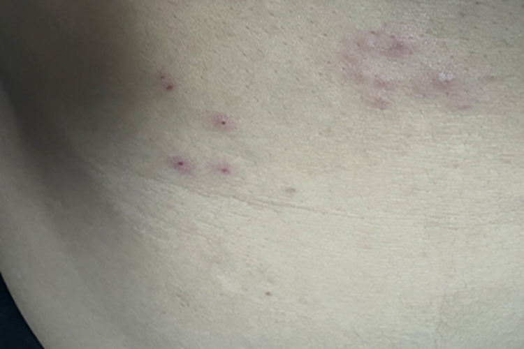 虫咬皮炎腹部红斑图