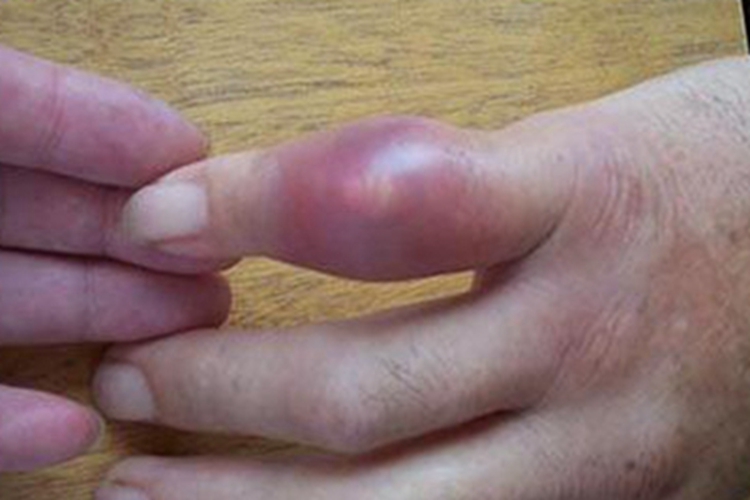 痛风手指关节严重肿胀发红图