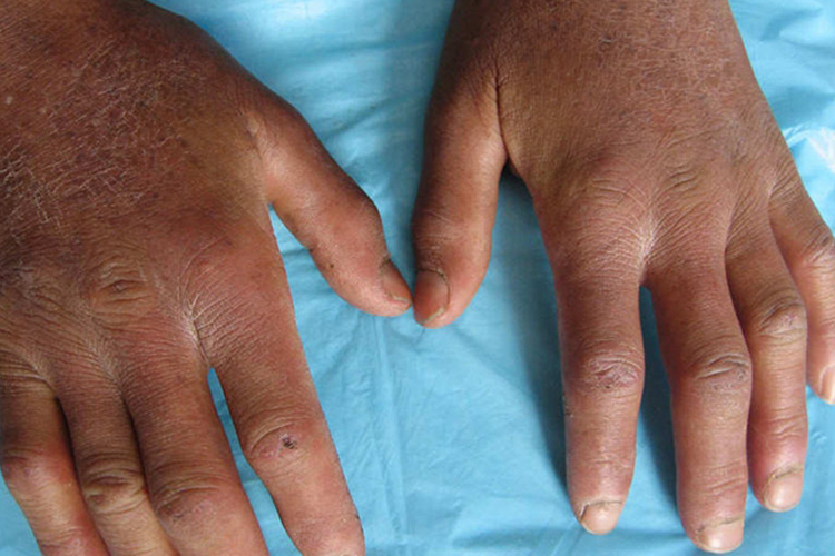 系统性硬皮病食指溃疡图 系统性硬皮病食指溃疡图