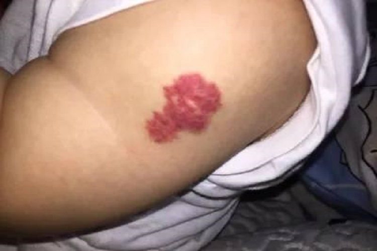 手臂上海绵状血管瘤图