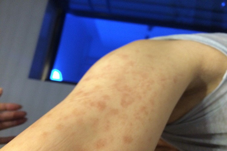 毛细血管扩张性环状紫癜胳膊斑图