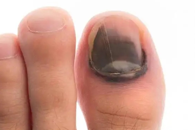 大脚趾头黑素瘤图