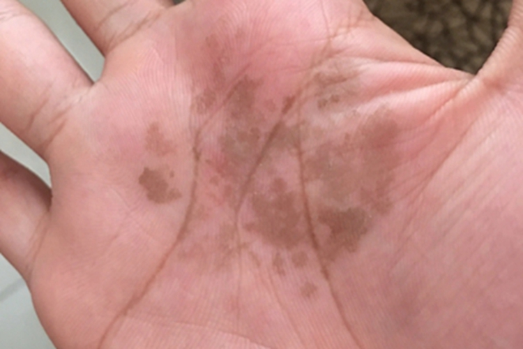 网状肢端色素沉着手心褐色斑块图