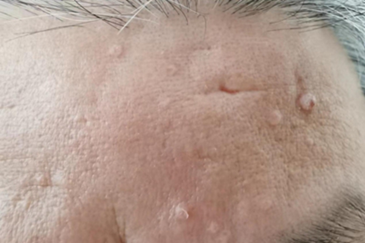寻常疣前额症状图 寻常疣前额症状图