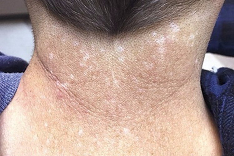 先天性角化不良后颈症状图