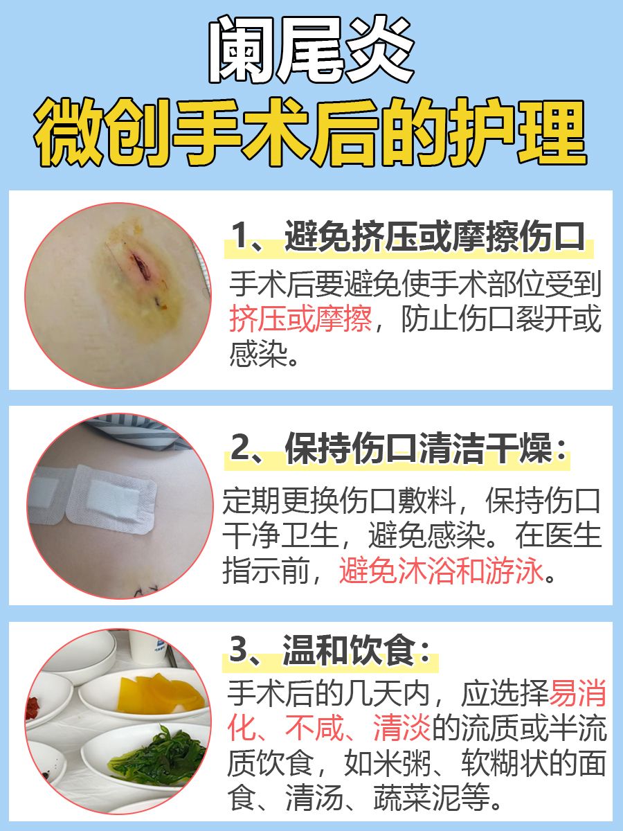 阑尾炎微创后，多久重回正常生活？看完不迷茫