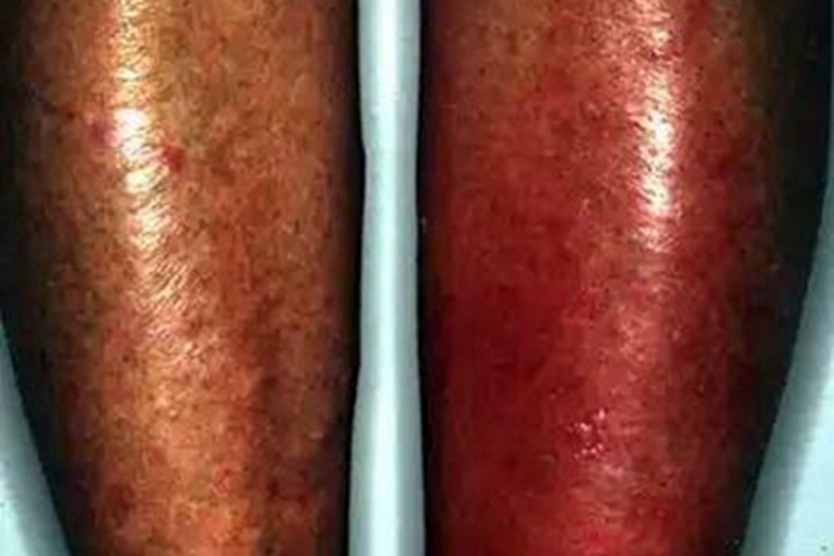 嗜酸性蜂窝织炎小腿红肿图 嗜酸性蜂窝织炎小腿红肿图