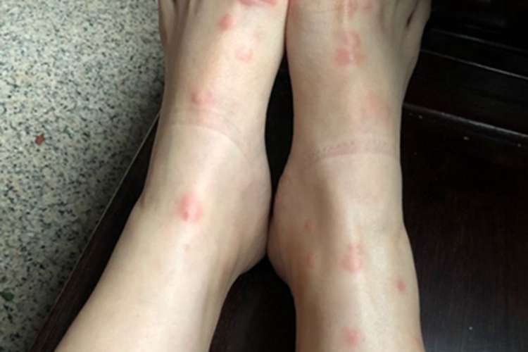跳蚤叮咬脚背症状图