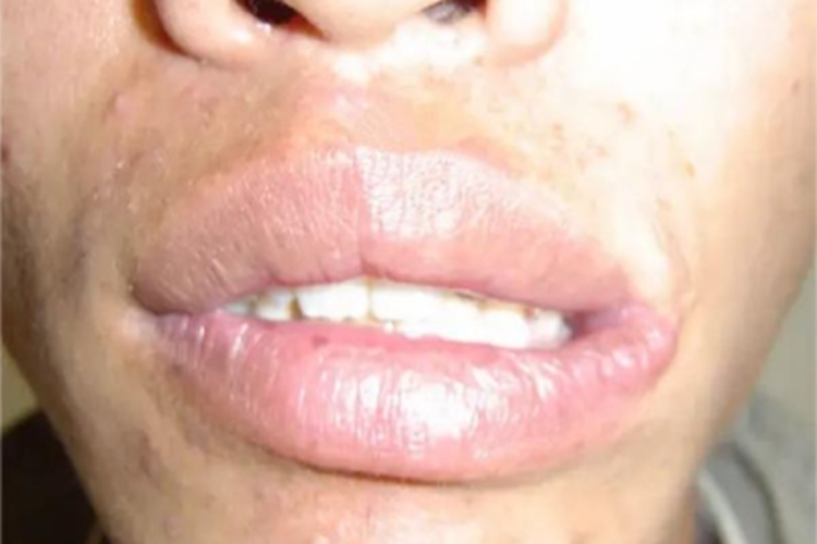 轻度大口畸形症状图