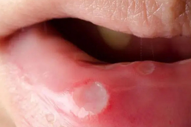 二期口腔梅毒下嘴唇有块白斑图