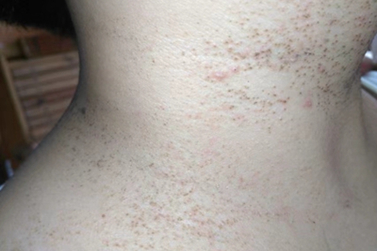 黑头粉刺样痣颈部皮肤粗糙图